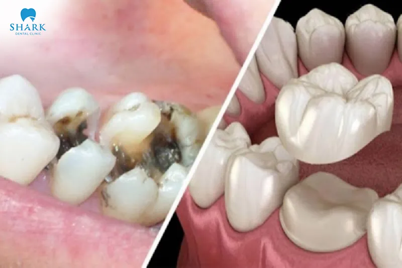 Dental crowns can still develop cavities if proper oral care and hygiene are not maintained