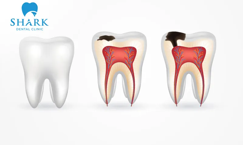 There are many different reasons why teeth can develop cavities or become damaged after crown placement
