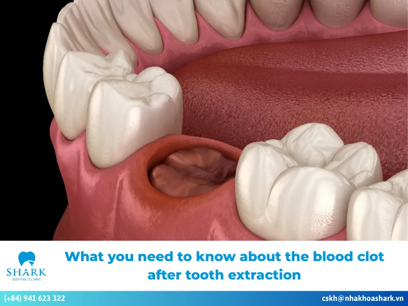 blood clot after tooth extraction