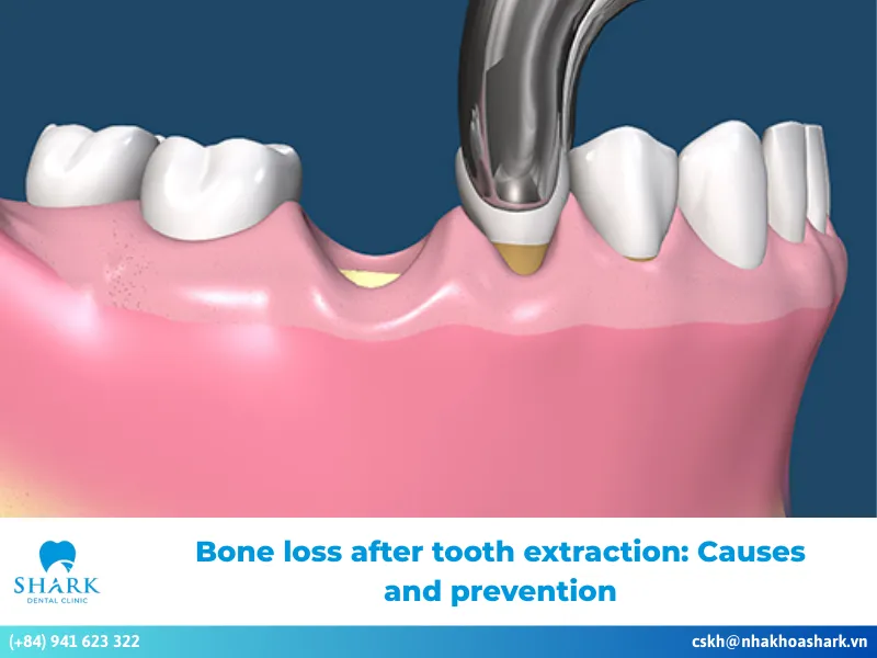 Bone loss after tooth extraction: Causes and prevention