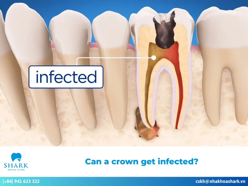 Can a crown get infected