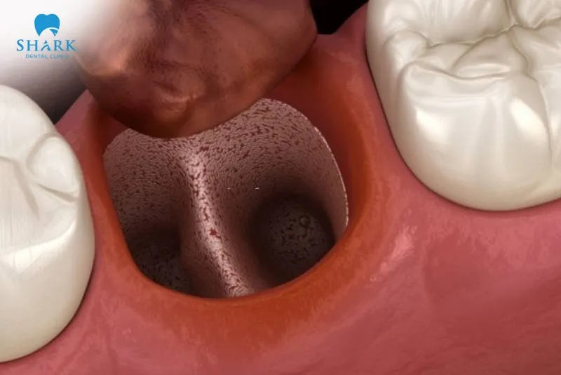 Dislodging the blood clot and developing dry socket are potential risks that can affect the wound if bread is eaten too early