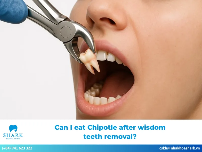 Can I eat Chipotle after wisdom teeth removal
