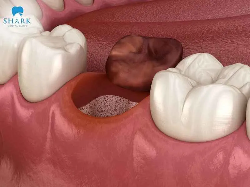 A blood clot after tooth extraction does not have a fixed color but changes through different stages of the healing process