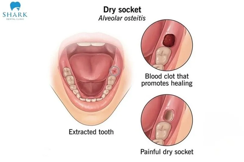 Dry socket is a complication that occurs when the blood clot does not form or becomes dislodged too early