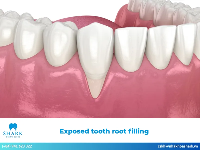 Exposed tooth root filling