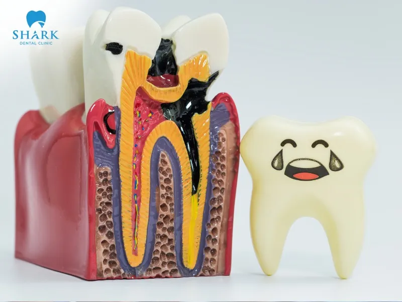 Bad breath after wisdom teeth removal may be caused by a dry socket or infection at the extraction site