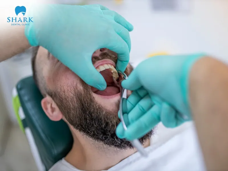 Sharp bone fragments after tooth extraction are often caused by the natural healing and bone regeneration process or by trauma