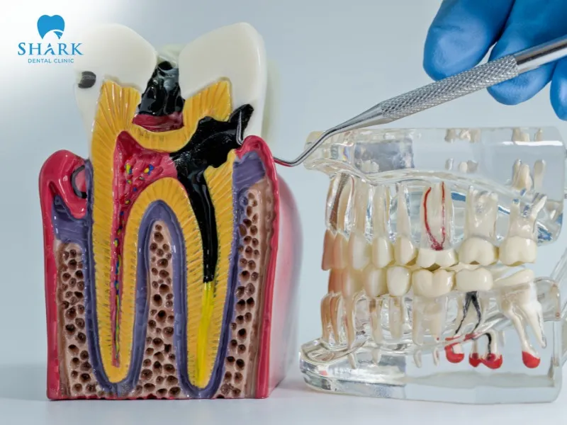 Bone spicules may disappear on their own after the wound has completely healed