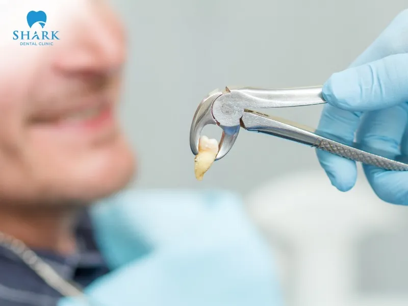 You should consider bicuspid tooth extraction if the tooth is crowded or causes a misaligned bite