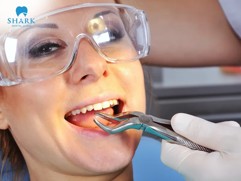Improper bicuspid tooth extraction can lead to gum swelling and bleeding