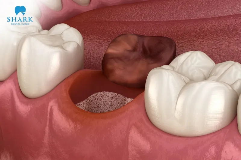 Eating hard and chewy foods too soon can dislodge the blood clot, easily leading to dry socket, causing pain and discomfort