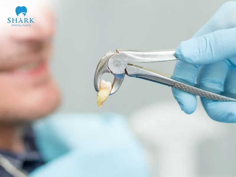 Tooth extraction helps eliminate the source of infection while protecting overall oral health