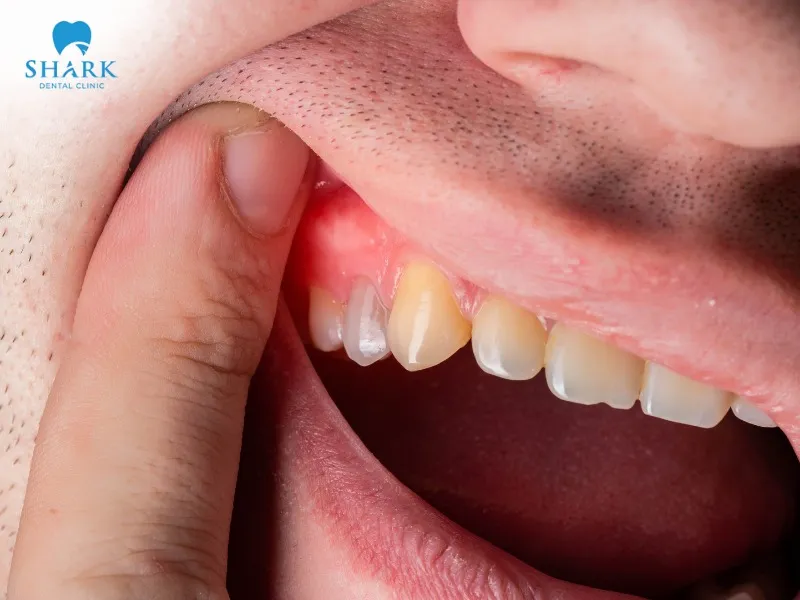 The appearance of a hard lump on the gum after tooth extraction is completely normal