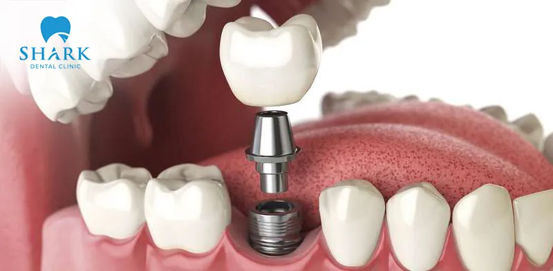 Dental implant placement is a safe and effective method for replacing missing teeth