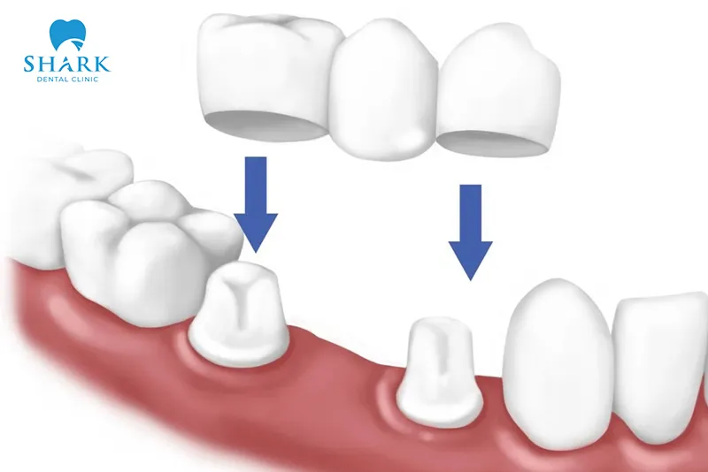 A dental bridge uses adjacent teeth as abutments to fill the gaps left by missing teeth
