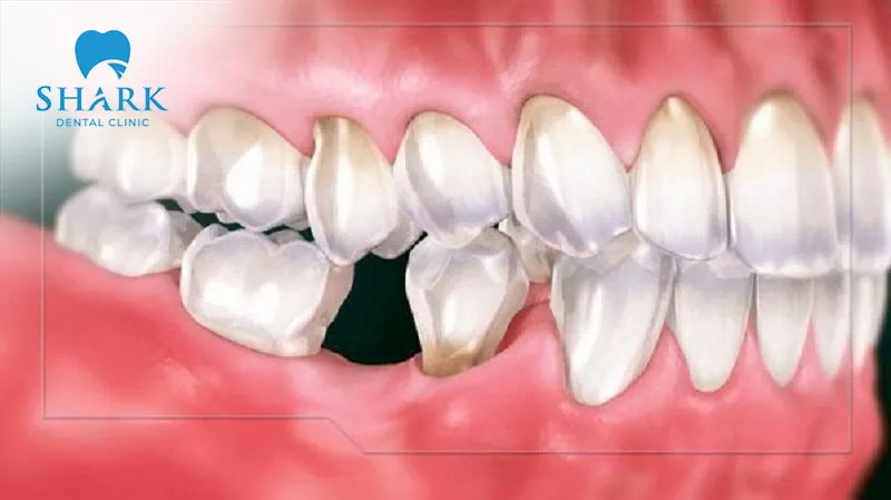 Loss of molar teeth can cause tooth shifting and structural changes, significantly affecting dental aesthetics