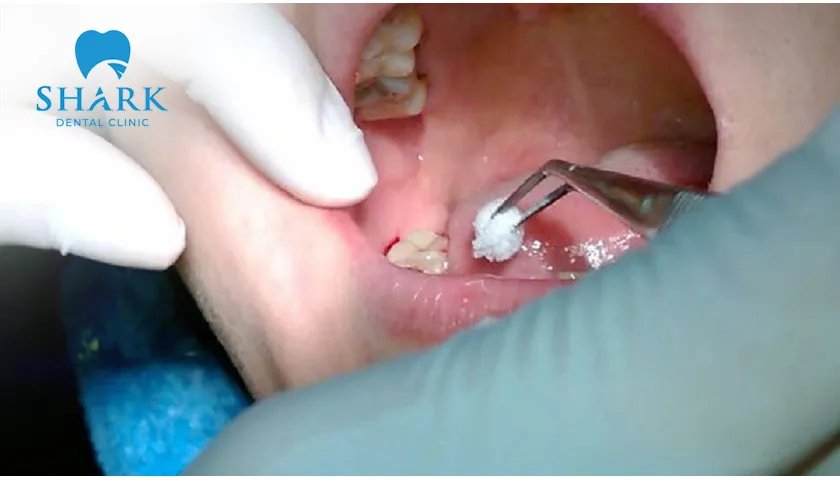 Follow proper post-extraction care and oral hygiene instructions after tooth removal