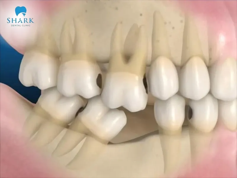 Jawbone loss after tooth extraction can result from many different causes
