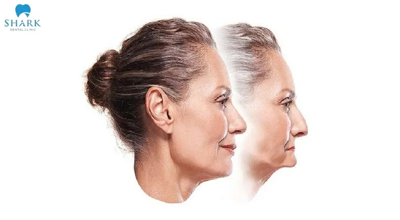 If bone loss is not addressed in a timely manner, it can negatively affect facial aesthetics