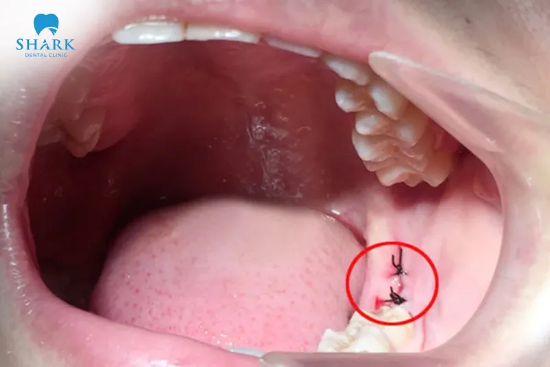 One of the factors affecting when you can eat chicken is the level of complexity of the tooth extraction procedure