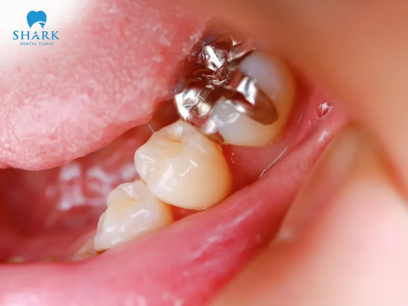 Silver tooth filling does not guarantee aesthetic results and may cause invasion of natural tooth structure in some cases