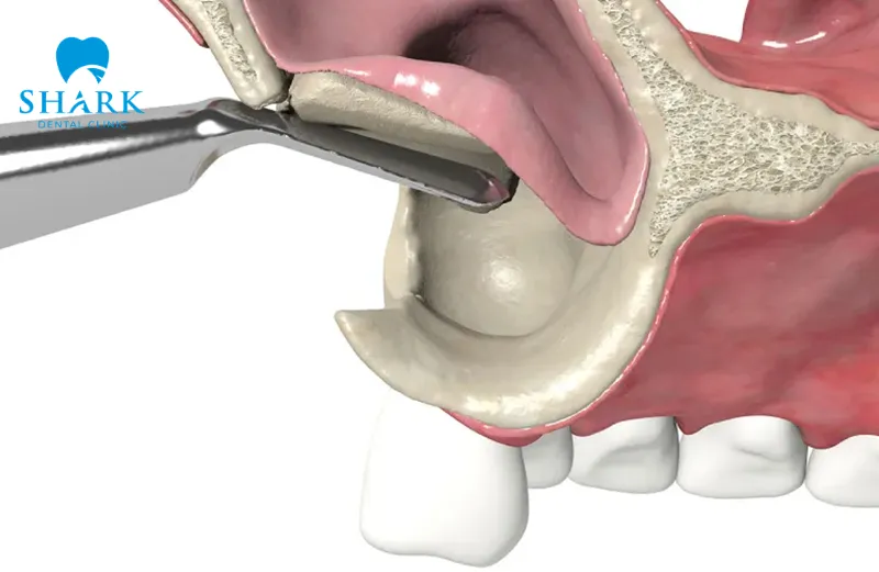 Open sinus lift is suitable for patients with severe jawbone loss