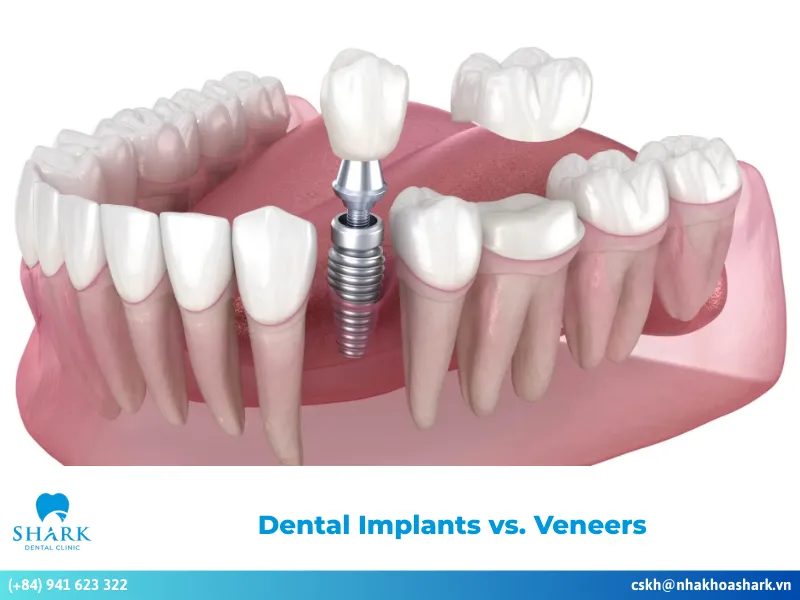 Dental Implants vs. Veneers