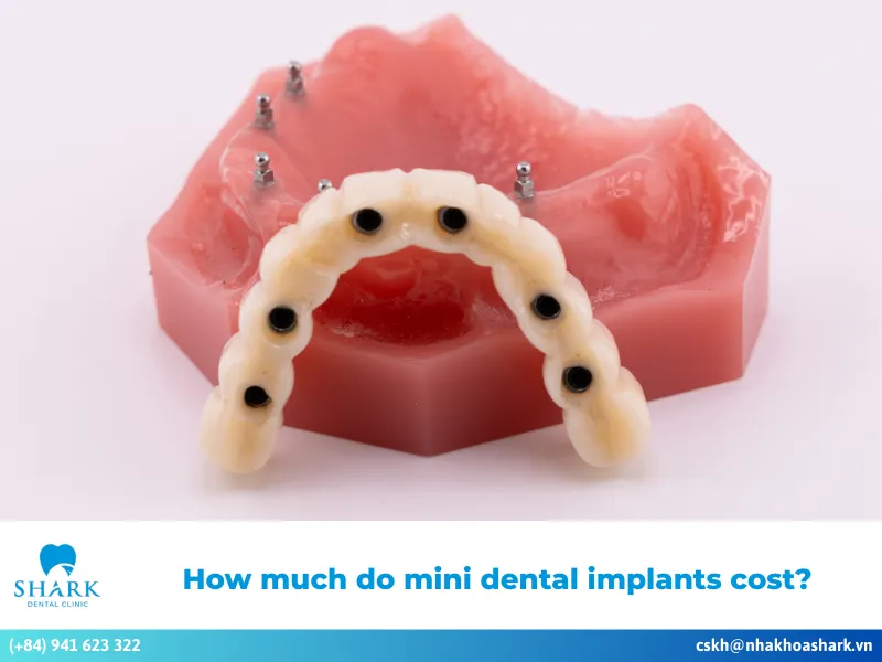 mini dental implants cost