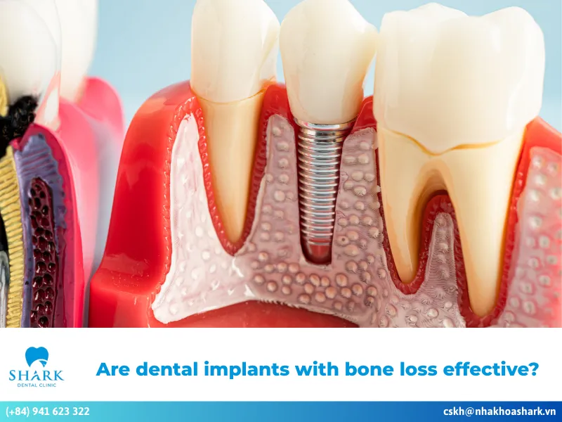 Are dental implants with bone loss effective?