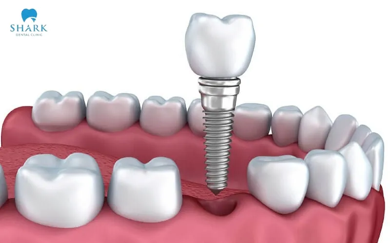 Despite their many advantages, screwless dental implants still have certain limitations, such as being suitable only for selected candidates and involving higher maintenance costs