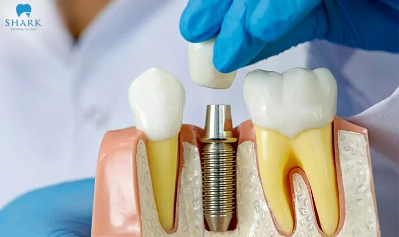 Screwless dental implants can last 15–25 years or even longer if proper care is maintained