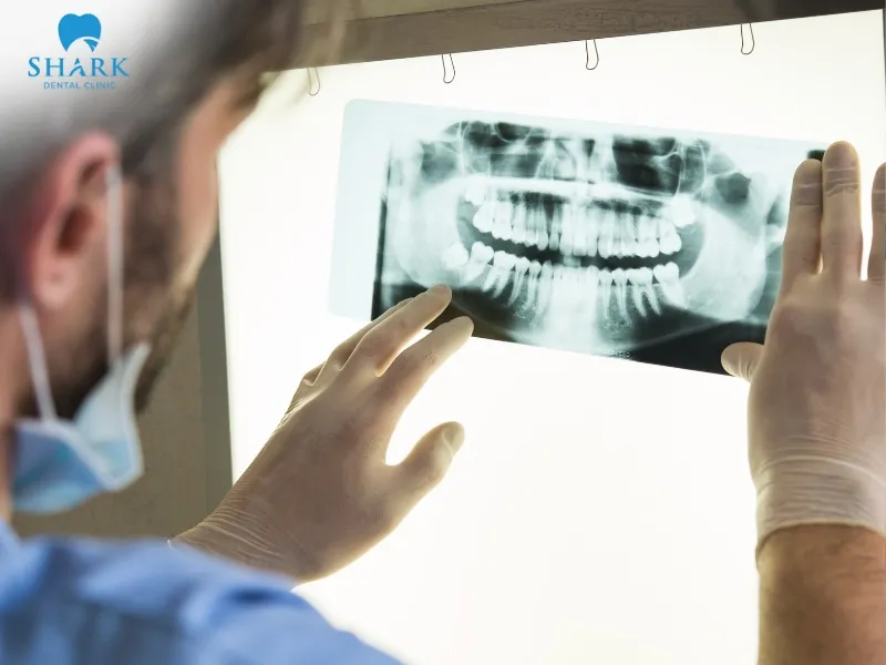 CT scans usually involve higher radiation levels compared to conventional dental X-rays