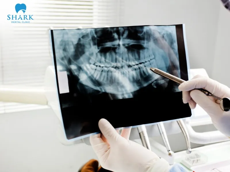 Dental X-rays help dentists accurately diagnose oral conditions and develop appropriate treatment plans
