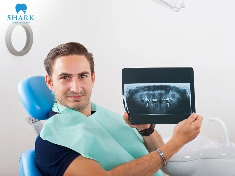Indications for X-ray imaging help detect early signs and accurately diagnose dental cavities