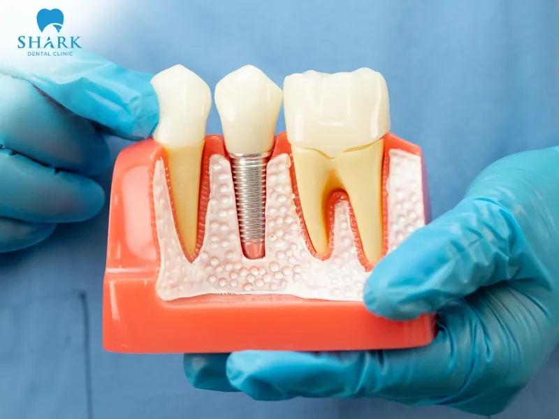 Tooth replacement is a solution for severe tooth decay cases where tooth extraction is unavoidable