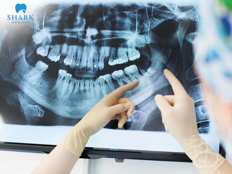 In healthy individuals, the jawbone typically appears as a bright white area on X-ray images