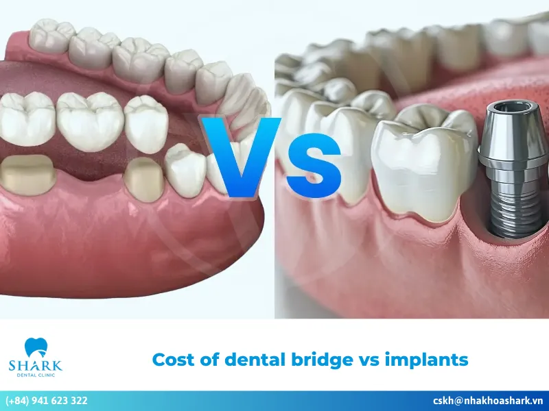 Cost of dental bridge vs implants