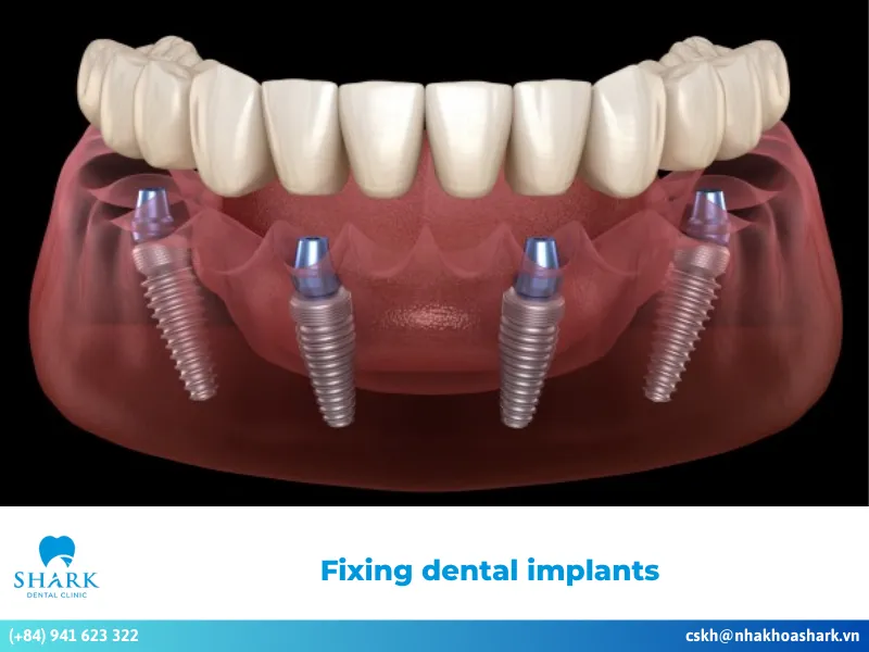 Fixing dental implants