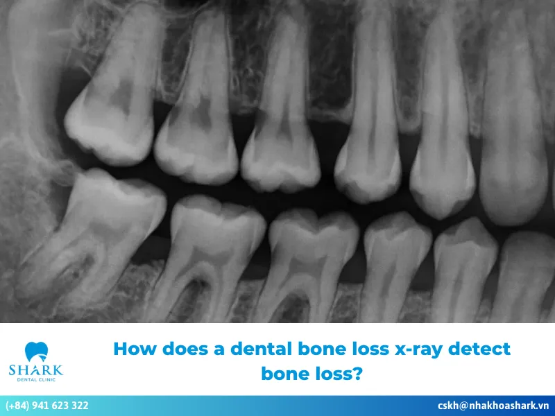How does a dental bone loss x-ray detect bone loss?