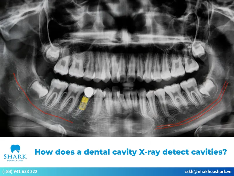 How does a dental cavity X-ray detect cavities?