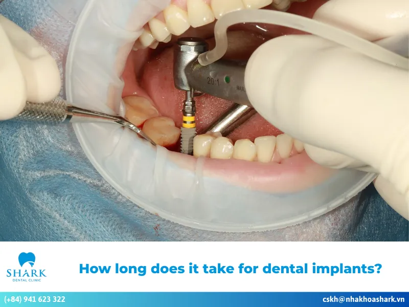 How long does it take for dental implants?