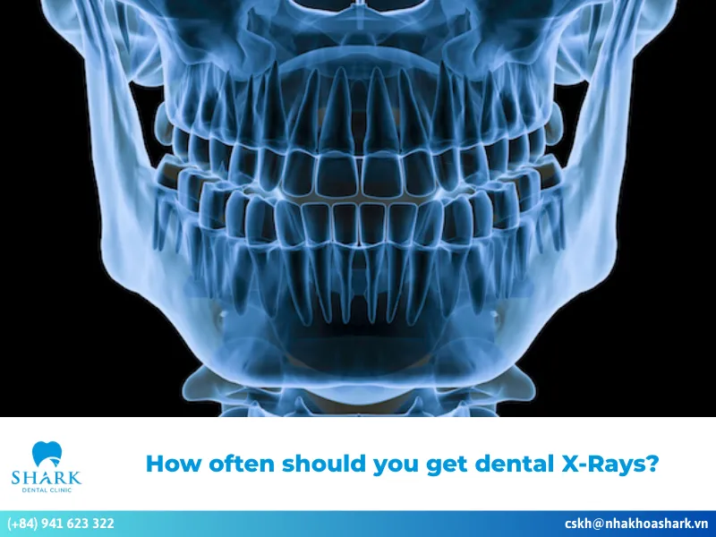 How often should you get dental X-Rays