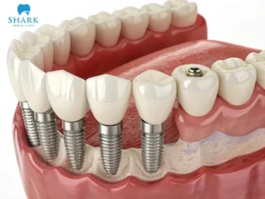 Frequently asked questions about dental implants