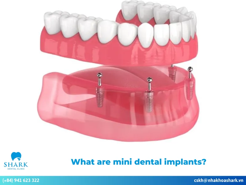 Mini dental implants