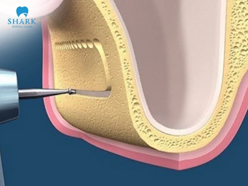 The cost of a sinus lift for one dental implant case typically ranges from 10,000,000 to 40,000,000 VND