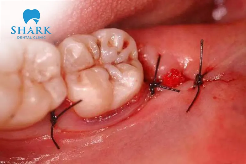 Brushing your teeth right after tooth extraction may cause infection and lead to unwanted complications
