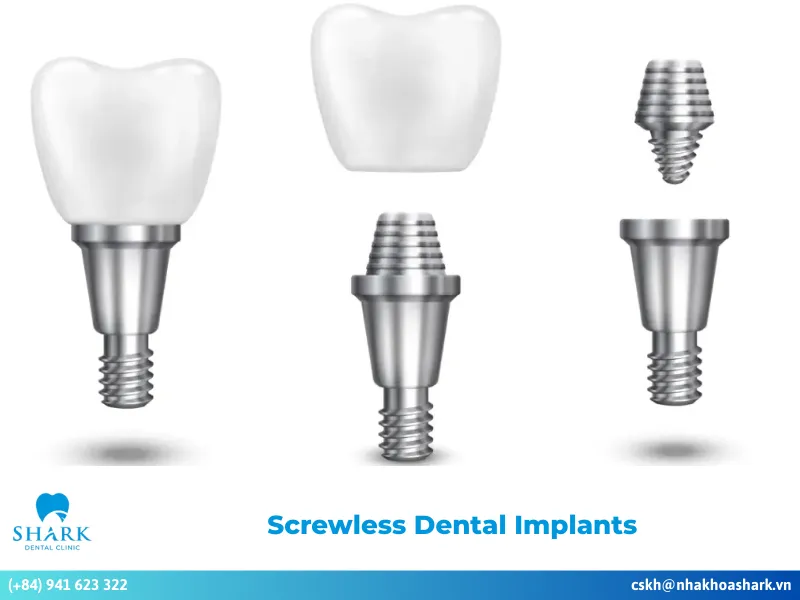 Screwless Dental Implants
