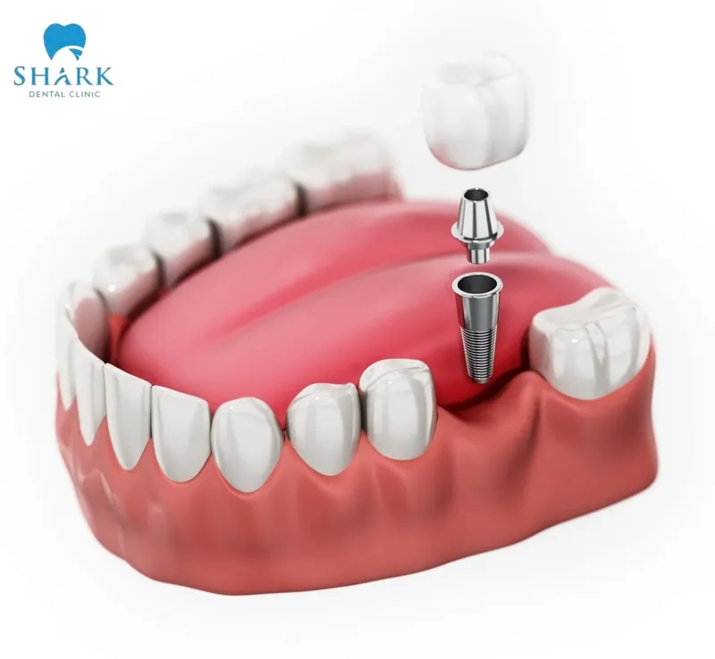 After restoration, dental implants function like natural teeth, effectively restoring chewing ability