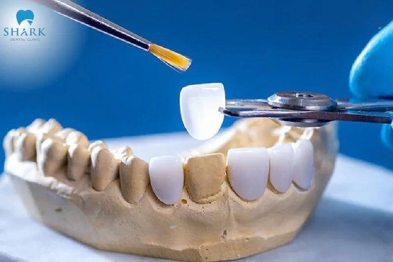 Porcelain veneers act like a thin shell that covers dental imperfections such as chips, discoloration, and surface defects